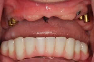Implant Supported Dentures Upper metal snap attachments on 4 implants