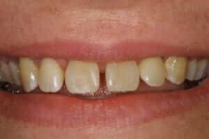 Porcelain Veneers Pre-treatment: "I don't like the gaps between my teeth and their color"