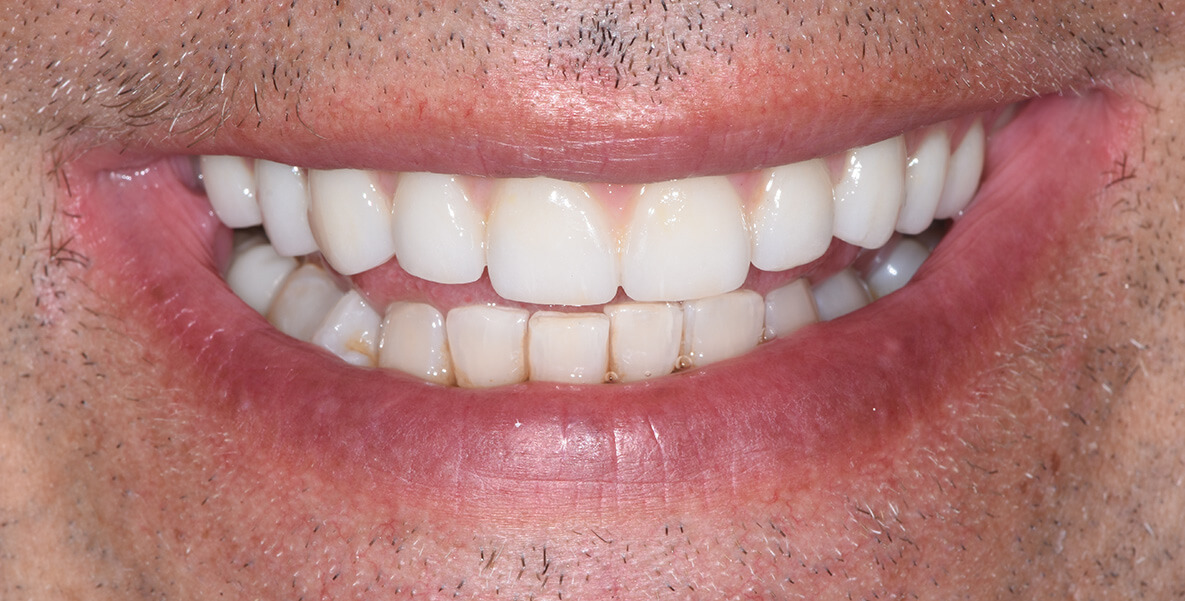 All On 4 AFTER: Feeling confident about his smile again, the patient's all-on-4 bridge is an major aesthetic and functional improvement. With proper care this bridge will last him 20+ years.