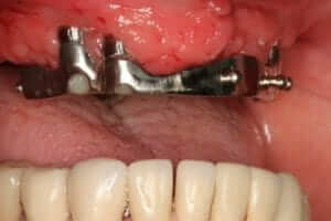 Implant Supported Dentures Upper 4 implant metal bar attachment for maximum stability