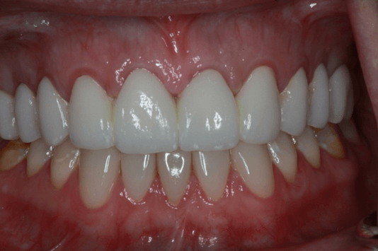 Gum Contouring After