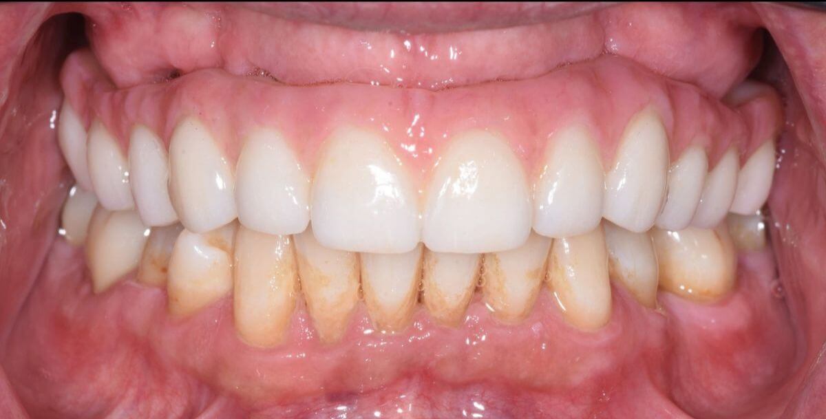 All On 4 AFTER: All-on-4 Treatment: Single arch zirconia (porcelain) bridge on 4 implants providing stable function and a confident smile.