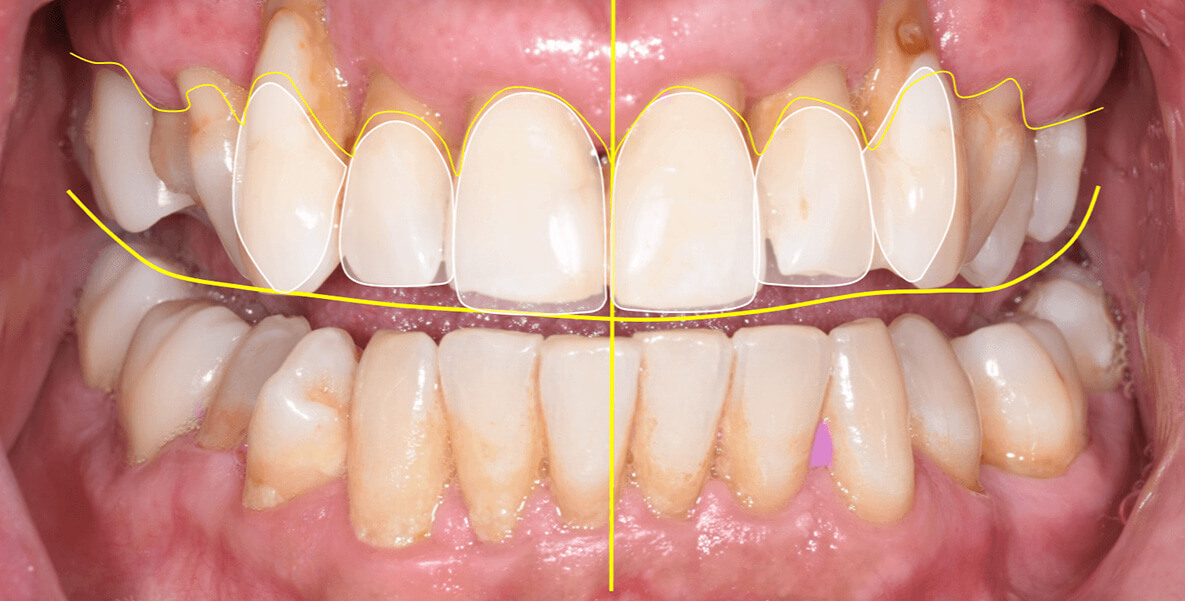 All On 4 BEFORE: We use intra oral scanning and 3D imaging to create a digital model of your mouth, allowing us to design your new smile and virtually plan the exact placement of your dental implants and your new temporaries before treatment begins.