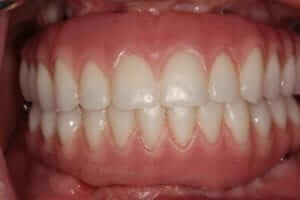 Full Arch Dental Implants Upper &amp; lower full arch implant fixed hybrid bridges close-up