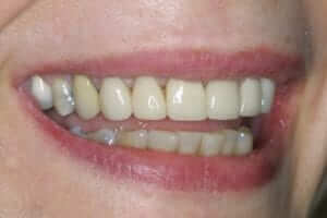 Reconstruction and Implants Pre-treatment: with unesthetic old crowns