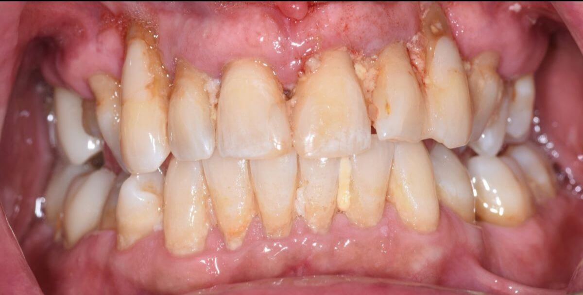 All On 4 BEFORE: Patient presented with multiple failing upper teeth due to periodontal disease with the inability to function and smile with confidence.